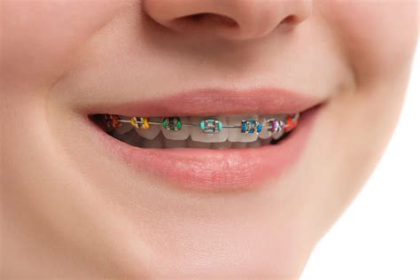 The Emotional Benefits of Witching Smile Teeth Braces
